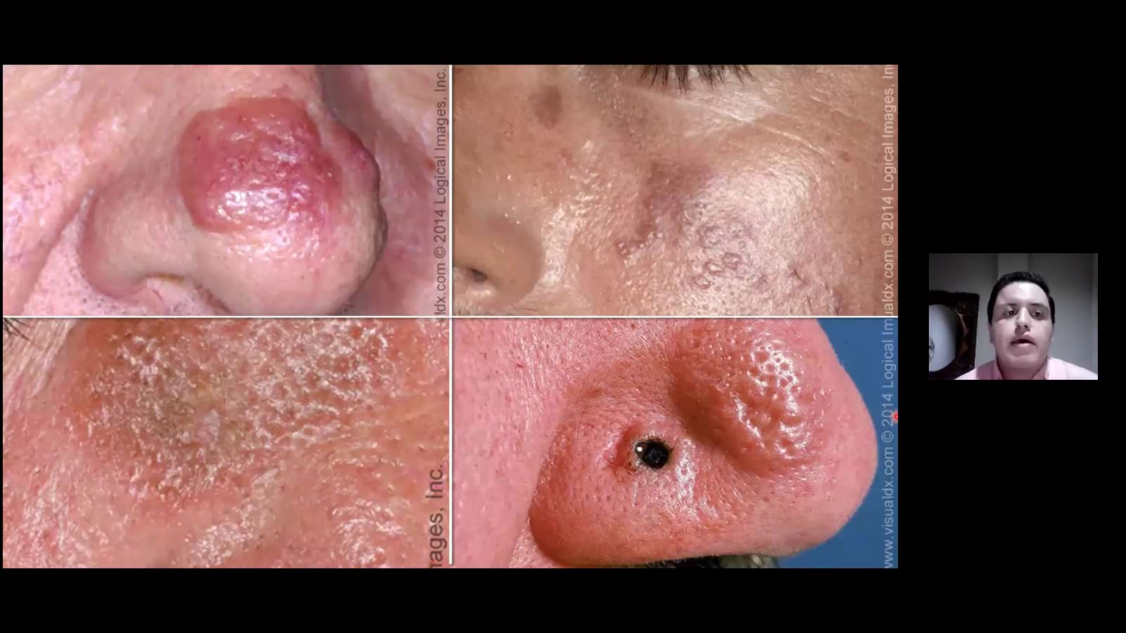 Granuloma Facial